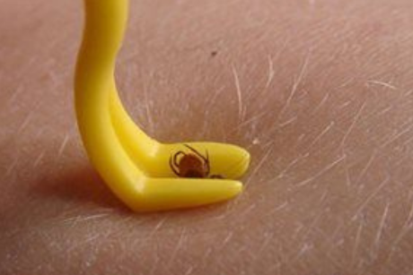 A tick being removed from the skin with a stick removal tool